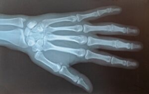 An x-ray of a left hand.