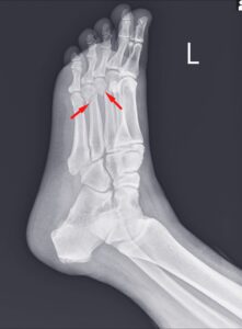  toe injury compensation