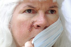 A close up picture of a woman with facial scarring.