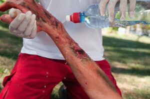 A man wearing red trousers and white gloves pouring a bottle of water over an arm with red sore burns.