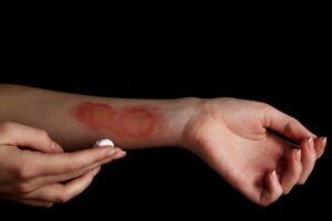 A female's wrist that has blistered burns on. She is about to apply cream to the burn using her other hand. 