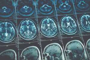 SEQUENCE OF BRAIN X-RAYS TO INDICATE CANCER MISDIAGNOSIS