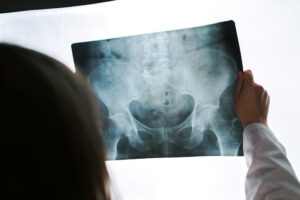 A doctor holding up an X-ray scan of a hip