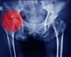 An X-ray scan of a hip with an area highlighted in red